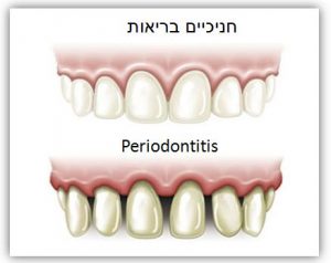 periodental_image