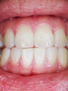 teeth-887338_640